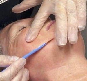 Dermaplaning