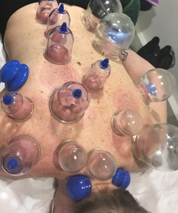 Chinese Fire Cupping Therapy Massage - Image 4