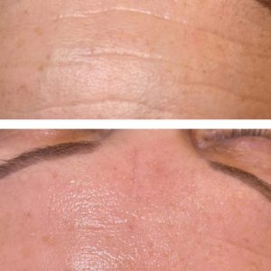 Collagen Silk Thread Lifting ONLINE TRAINING with CPD accreditation - Image 3
