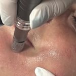 Microneedling/Dermaroller Training