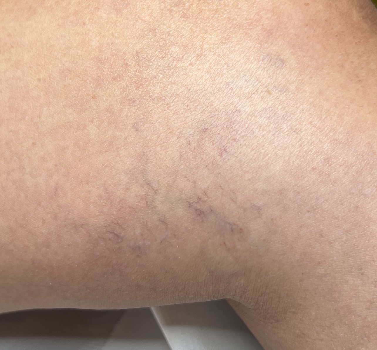 Sclerotherapy CPD Course